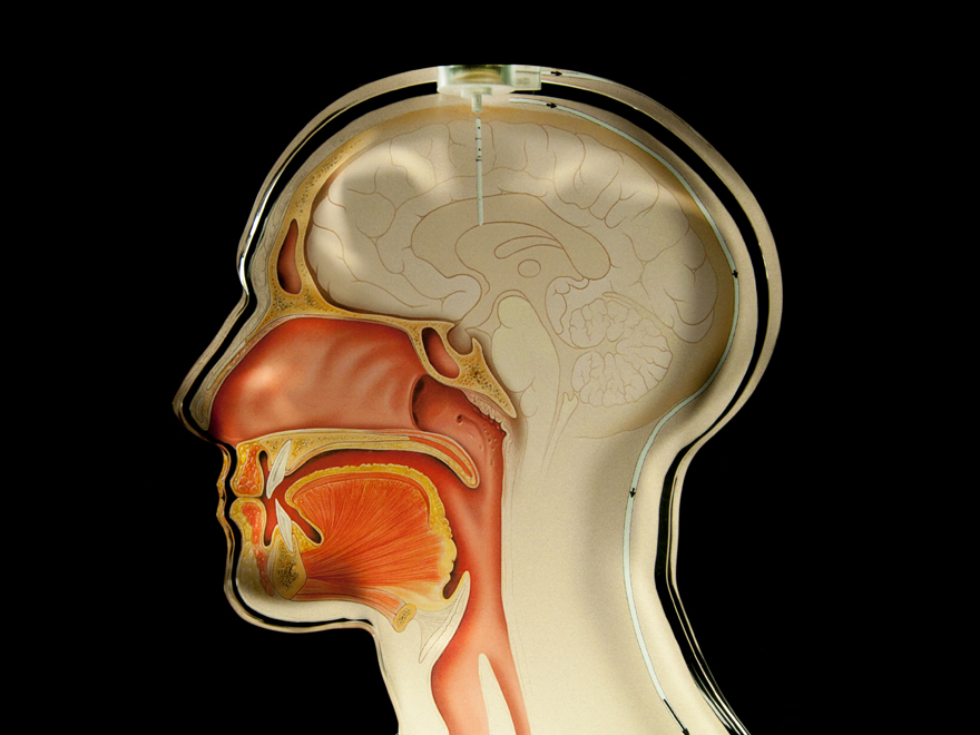 Schematischer Querschnitt durch einen Kopf, der die Platzierung des Hydrozephalus-Sensors anzeigt