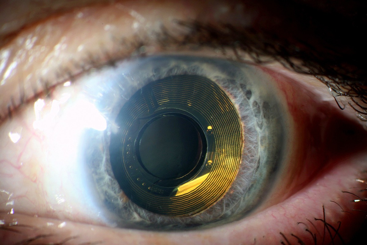 Retina implant in human use